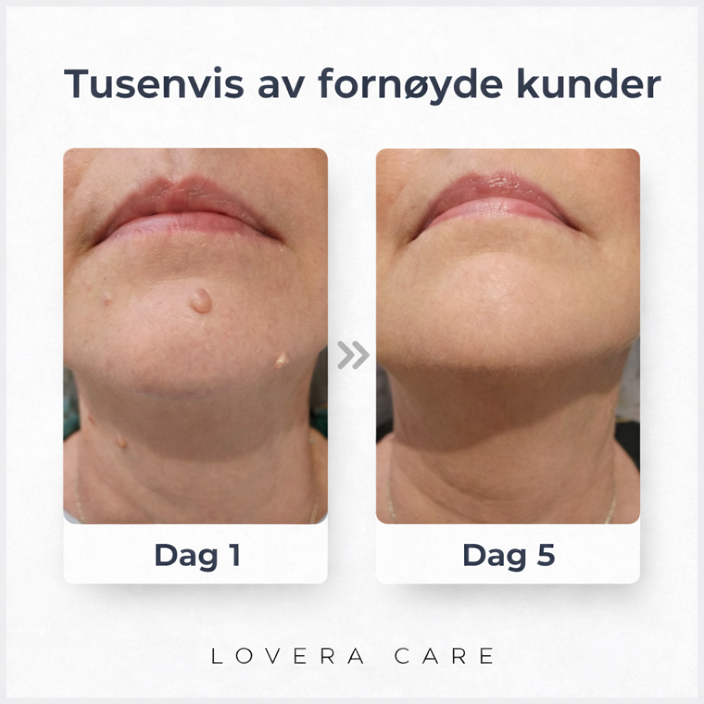 Lovera Care - Hudlapper